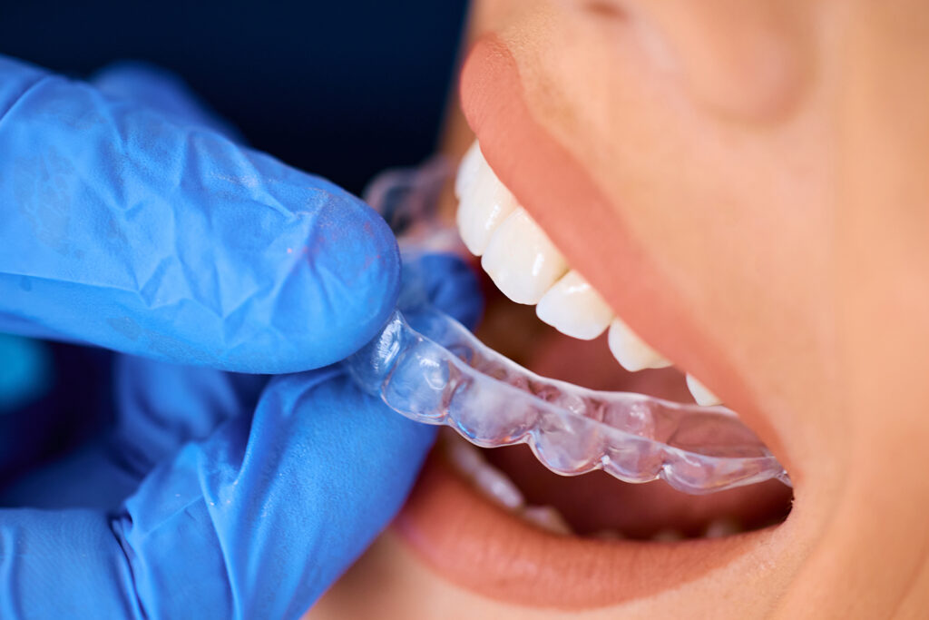 Clear Aligners - Spark Aligners