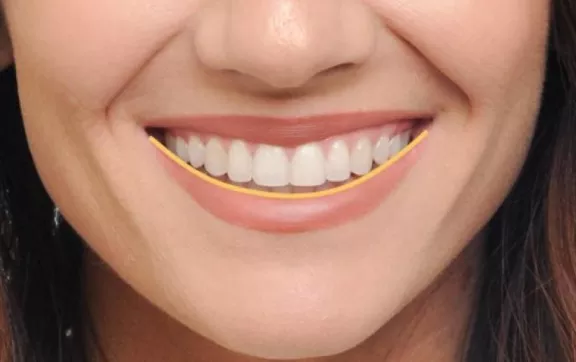 Damon Braces