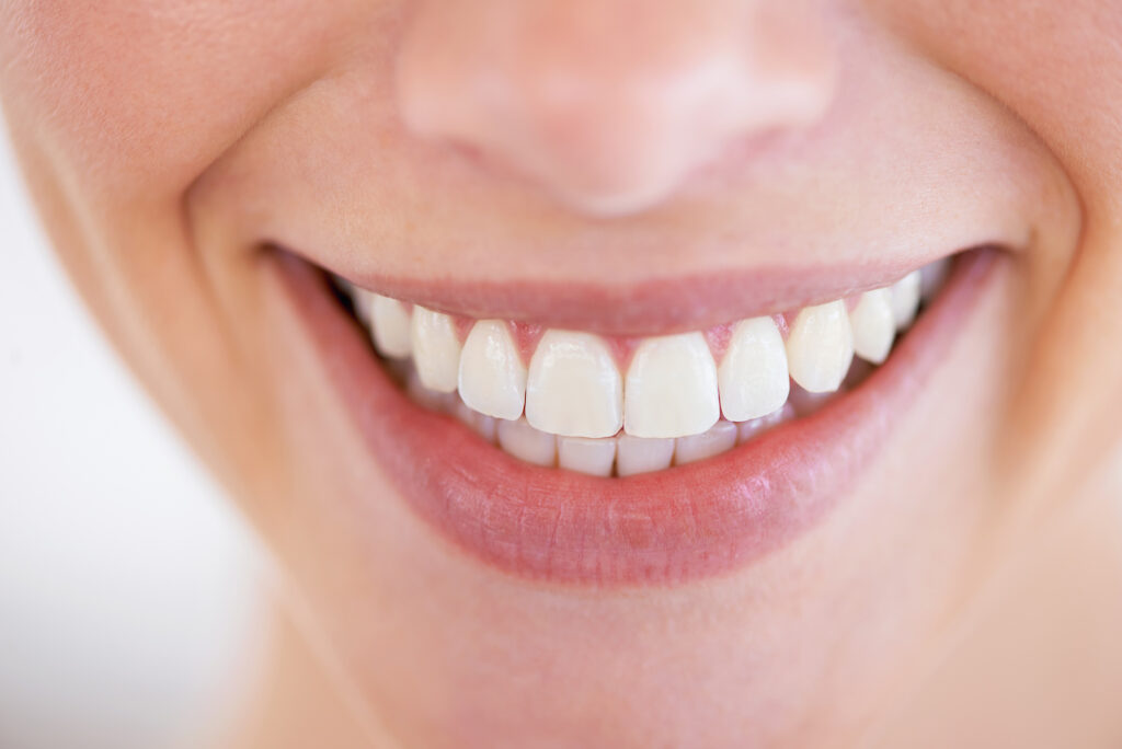 Hinton Smile